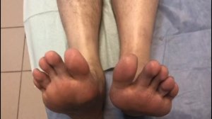 Лечение полного разрыва ахилла, 51 день