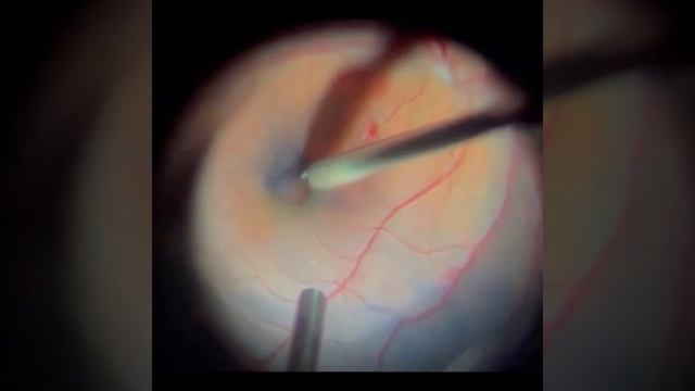 ILM Peeling + PRP. Inverted ILM Flap Technique. Мембранопилинг + PRP. Техника “перевернутый лоскут”
