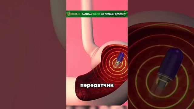 Как происходит капсульная эндоскопия???
