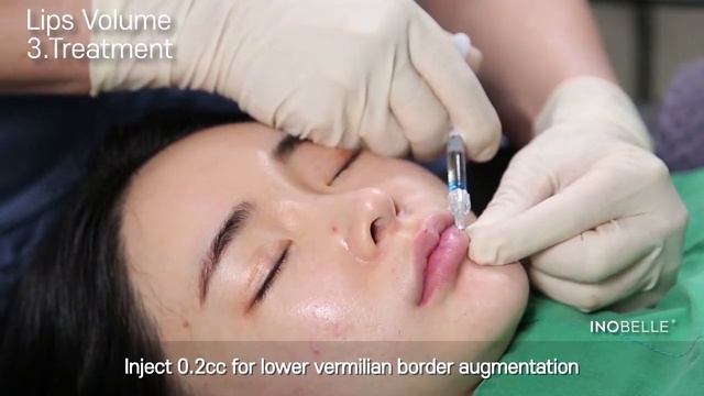 [GCS] INOBELLE - Creating Volume (Lips) смотреть онлайн