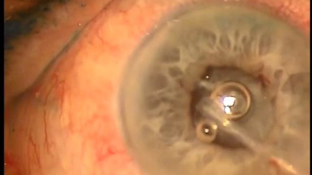 Use of Fugo plasma blade in management of anterior capsular contraction syndrome. смотреть онлайн