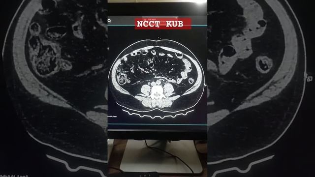 NCCT KUB | CT KUB | HYDRONEPHROSIS #kidney #ureter #bladder #radiology #ctscan @hemantkushwah3453 смотреть онлайн