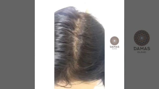 Активация роста волос : мезотерапия кожи головы