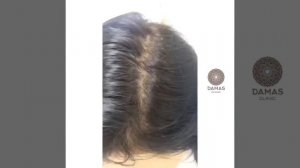 Активация роста волос : мезотерапия кожи головы