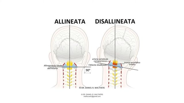 Cos'è la Chiropratica Upper Cervical? смотреть онлайн