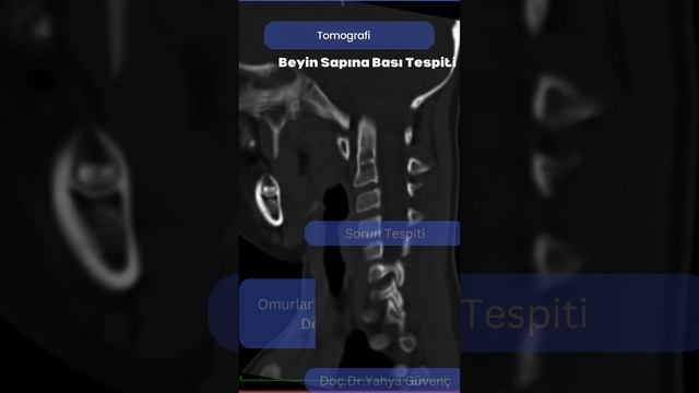 Boyun Omurga Kırıkları Ve Kaymaları