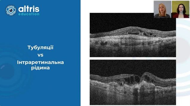 Тубуляції зовнішньої сітківки, значення та диференціальна діагностика