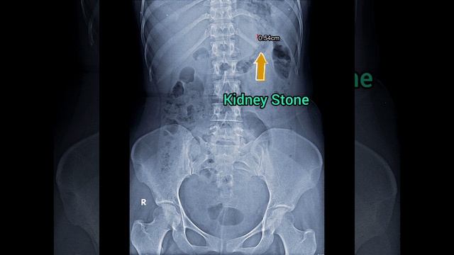 Kidney Stone In KUB X ray #shortsvideo смотреть онлайн