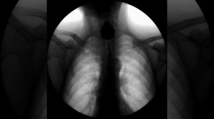 Дивертикул Ценкера, рентгеноскопия пищевода