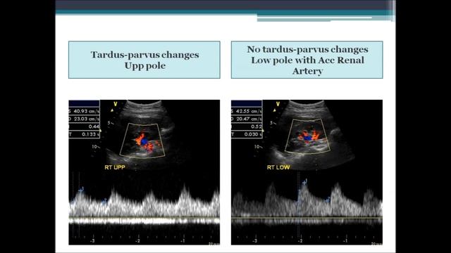 Renal Artery Doppler Ultrasound From Start To Finish