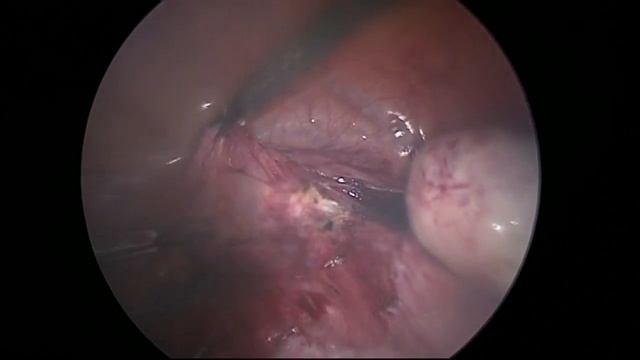 Laparoscopic hysterectomy using Lap BiSect Micro (ERBE). Prof Shtyrov. S.V. смотреть онлайн