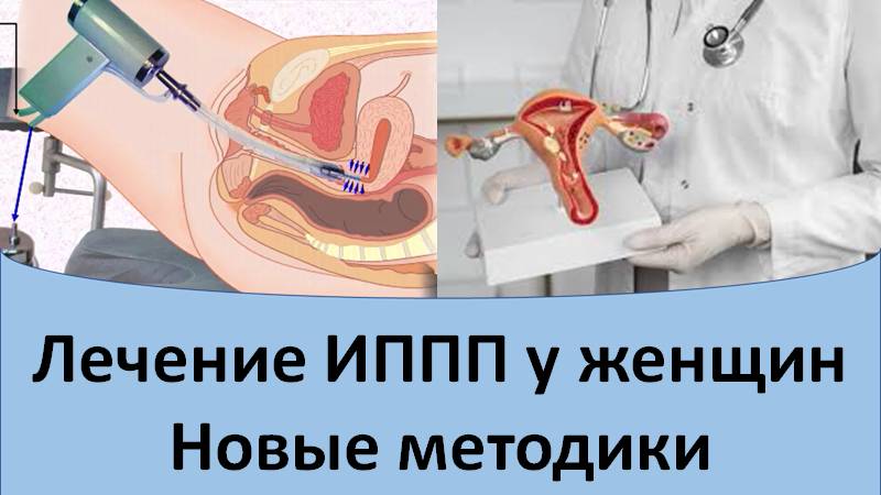 Лечение ИППП у женщин. Новые процедуры смотреть онлайн
