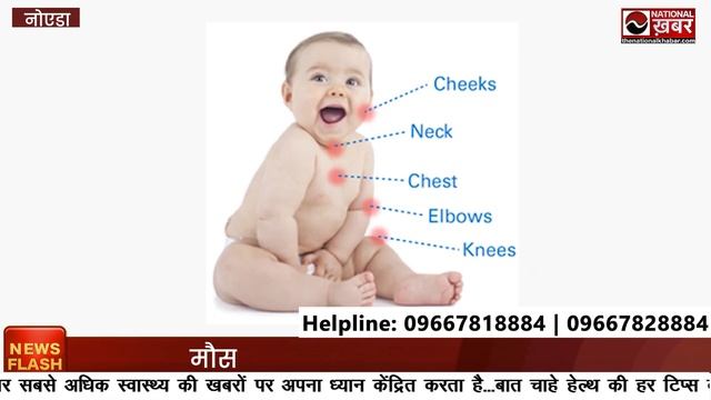 Atopic Dermatitis क्या है ? जानिए लक्षण और इलाज ! La Fameux Derma | National Khabar