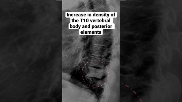 Blastic metastatic cancer to the spine causing an ivory vertebra #xray #radiology #medical смотреть онлайн