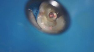 извлечение остатков гуттаперчи