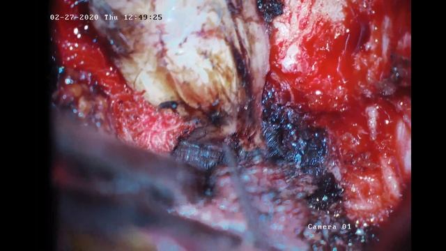 Мікрохірургічне видалення пухлини спинного мозку