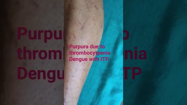 dengue with underlying immune thrombocytpenic purpura (ITP)#dengue#denguefever#ITP#purpura смотреть онлайн