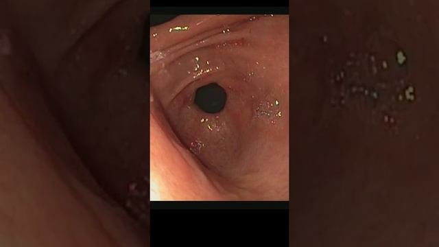 stomach acid dissolve metal also.HCl pH 1-2 смотреть онлайн