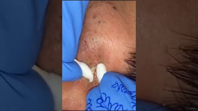 Blackheads Removal#27 смотреть онлайн