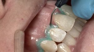 Как использовать Opalustre™, cуспензию для микроабразивной обработки эмали?