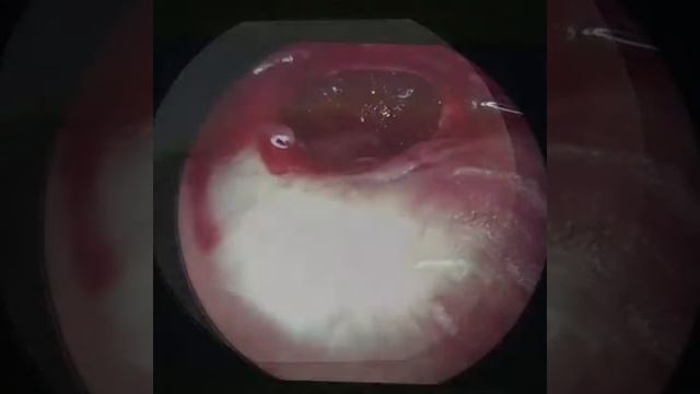Uzman Dr. Elnur Akbarov l Endoscopic Myringoplasty (Endoskopik mirinqoplastika) смотреть онлайн