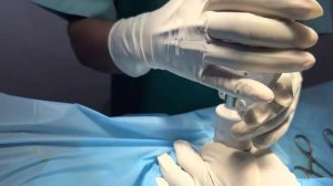Stapler Circumcision Surgery. ಸ್ಟಾಪ್ಲರ್ ಮುಂಜಿ ಶಸ್ತ್ರಚಿಕಿತ್ಸೆ. Dr C Sharath Kumar, Sexologist, B’Lur