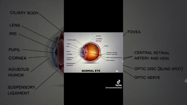 Retinal Detachment #retinaldetachment #opthalmology #medicine #fypシ #fyp #foryoupage #foryou #4you