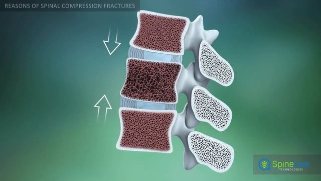 Spinal Compression Fracture Reasons смотреть онлайн