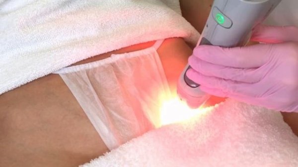 Лазерная эпиляция зоны бикини