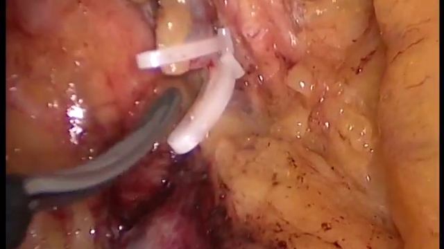 Laparoscopic D3 Right Colectomy смотреть онлайн
