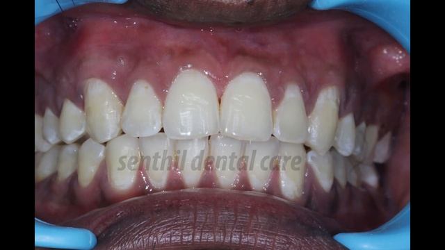 Teeth Gap Closure In Chennai | Affordable Self Ligating Braces Treatement | Dr.MKP Invisalign Clini смотреть онлайн