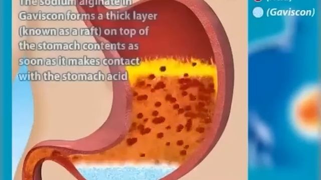 Gaviscon Original. How it works. смотреть онлайн