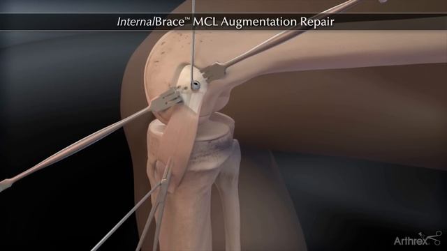 InternalBrace™ MCL Augmentation Repair смотреть онлайн