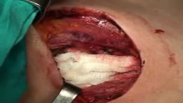 Total Tiroidektomi Ameliyatı смотреть онлайн