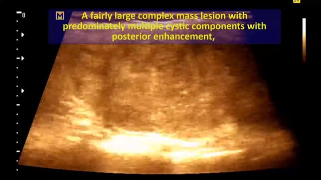 Ultrasound cases 46 of 2000 - Video Showing Benign Thyroid Adenoma смотреть онлайн