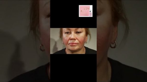 Стройность.Липолитик.