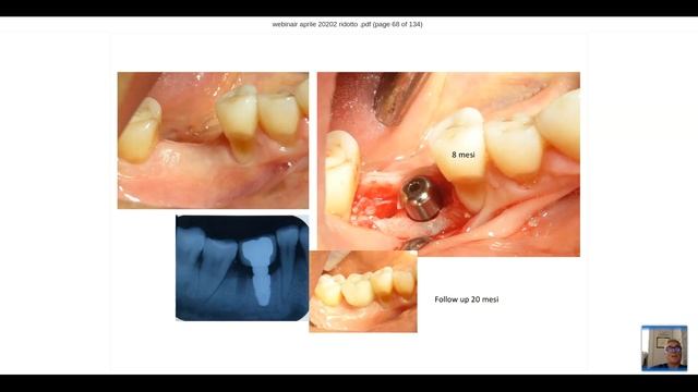 Tooth Transformer: Estudios multicéntricos y estudios comparativos con otros materiales de injerto смотреть онлайн