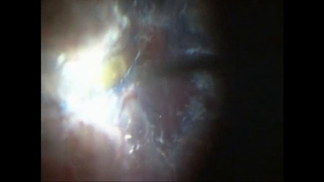 Retinal Detachment with Advanced PVR смотреть онлайн