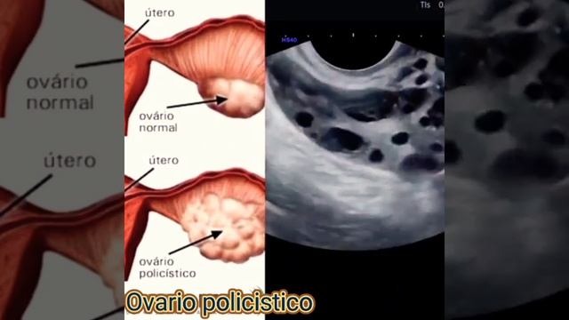 Ovario policistico. смотреть онлайн