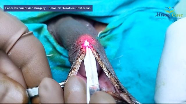 Laser Circumcision Surgery (No Bleeding) For Balanitis Xerotica Obliterans (BXO) Of 40 Yrs. Old Mal