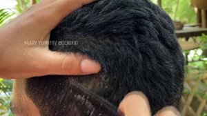 Dandruff Removal With Comb!! Dandruff Scratching Psoriasis #216