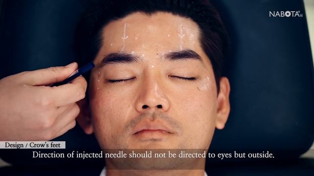 Kỹ thuật tiêm Nabota Botox 100dv смотреть онлайн