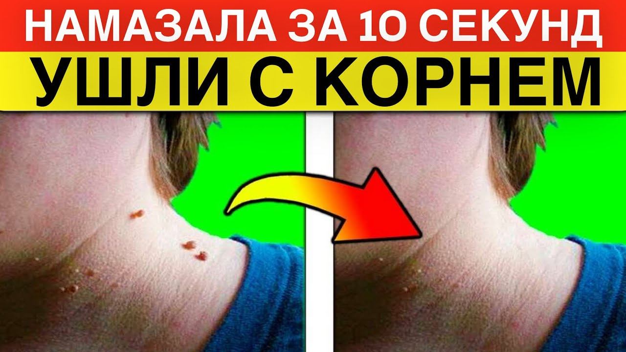 ПАПИЛЛОМЫ УХОДЯТ С КОРНЕМ!!!  #папилломы