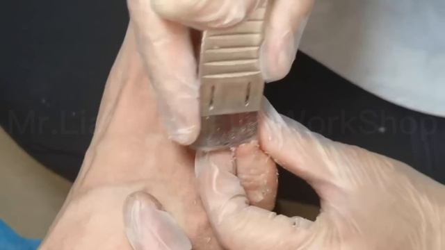 10MINS Pedicure. Callus Treatment & Callus Removal. Fungal Nails Treatment & Ingrown  Nails Removal