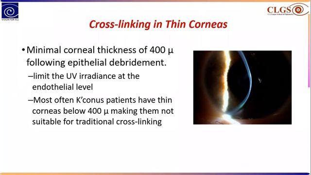 C3R Approach to Keratoconus смотреть онлайн