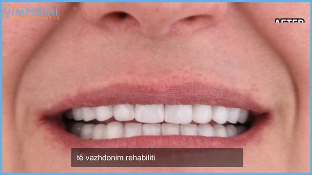 URA ZIRKONI-PORCELAN 🦷 ZIRCONIUM-PORCELAIN BRIDGE 🦷 ZIRCONIA-PORCELLANA PONTE смотреть онлайн