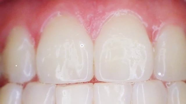 SHY Oral Gel Benefits and side effects in Hindi//Potassium Nitrate Triclisan with Fluoride Gel// смотреть онлайн