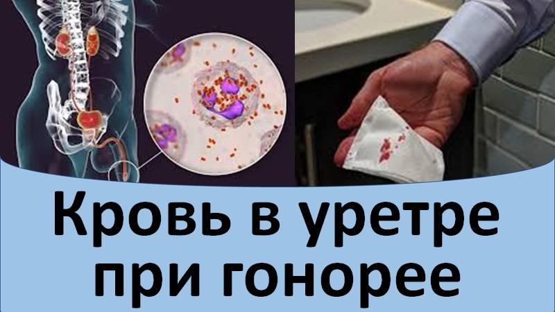 Кровь в уретре при гонорее смотреть онлайн
