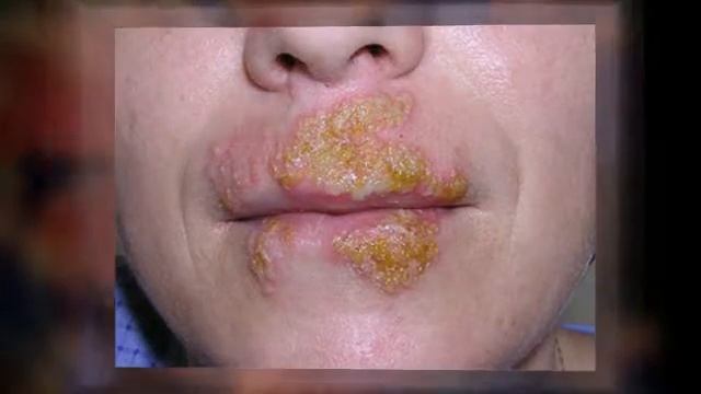 The Process Of Having Herpes Zoster Shingles смотреть онлайн