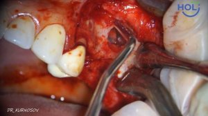 Повторный открытый синус-лифтинг, перфорация и парашют